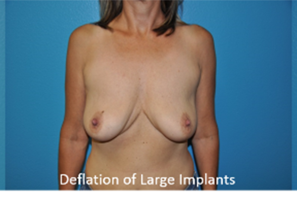 Breast Revisions
