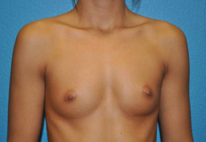 Augmentation Case 269 Before Photo Augmentation