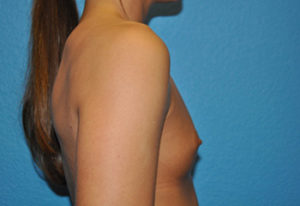 Augmentation Case 269 Before Photo Augmentation
