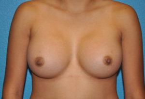 Augmentation Case 270 After Photo Augmentation