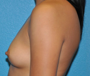 Augmentation Case 270 Before Photo Augmentation