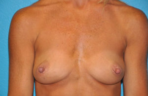 Augmentation Case 272 Before Photo Augmentation