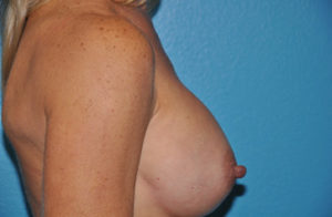 Augmentation Case 272 After Photo Augmentation