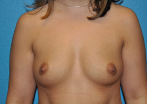 Augmentation Case 273 Before Photo Augmentation