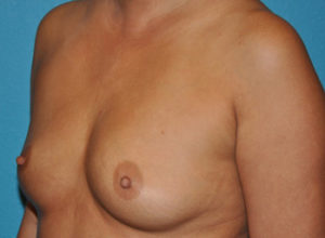 Augmentation