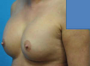 Augmentation