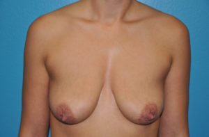 Augmentation Mastopexy Case 278 Before Photo Augmentation Mastopexy
