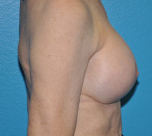 Augmentation Mastopexy Case 339 After Photo Augmentation Mastopexy