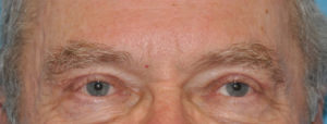 Blepharoplasty
