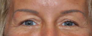 Blepharoplasty