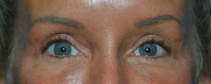 Blepharoplasty