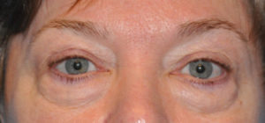 Blepharoplasty