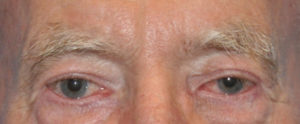 Blepharoplasty