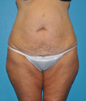 Body Contouring
