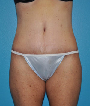 Body Contouring
