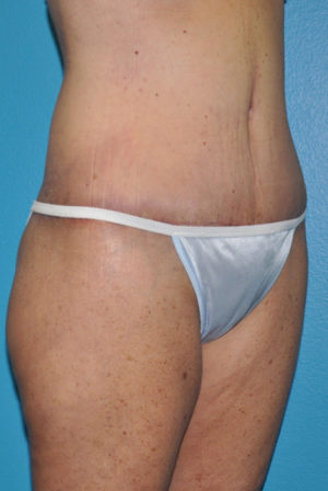 Body Contouring