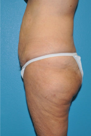 Body Contouring