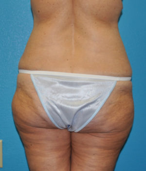 Body Contouring