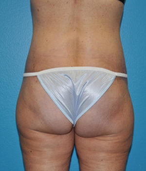 Body Contouring