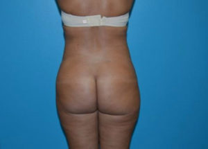 Brazilian Butt Lift
