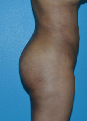 Brazilian Butt Lift Case 391 After Photo Brazilian Butt Lift