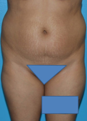 Brazilian Butt Lift Case 391 Before Photo Brazilian Butt Lift