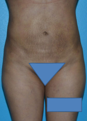 Brazilian Butt Lift Case 391 After Photo Brazilian Butt Lift