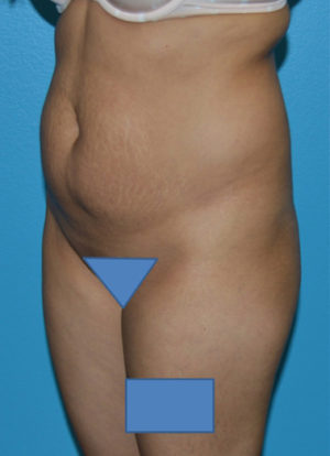 Brazilian Butt Lift Case 391 Before Photo Brazilian Butt Lift