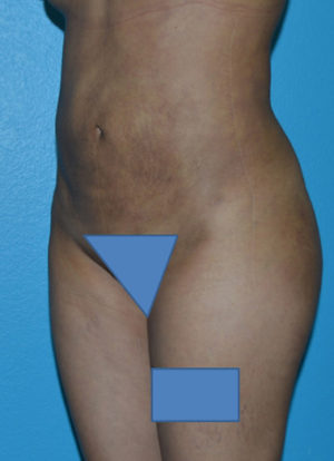 Brazilian Butt Lift Case 391 After Photo Brazilian Butt Lift