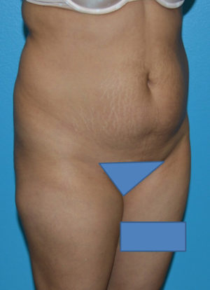 Brazilian Butt Lift Case 391 Before Photo Brazilian Butt Lift