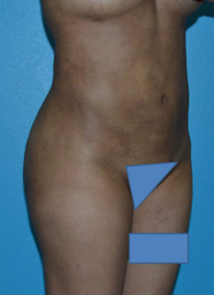 Brazilian Butt Lift Case 391 After Photo Brazilian Butt Lift