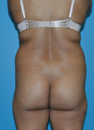 Brazilian Butt Lift Case 391 Before Photo Brazilian Butt Lift
