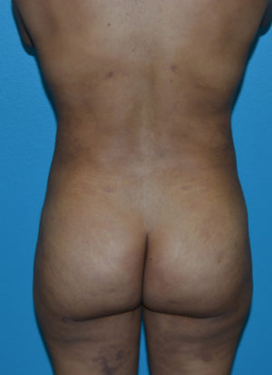 Brazilian Butt Lift Case 391 After Photo Brazilian Butt Lift