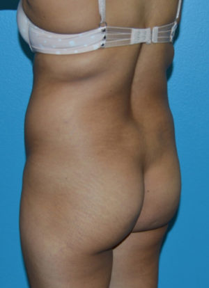 Brazilian Butt Lift Case 391 Before Photo Brazilian Butt Lift