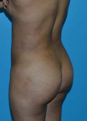 Brazilian Butt Lift Case 391 After Photo Brazilian Butt Lift