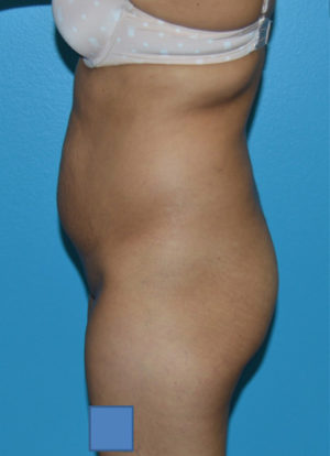 Brazilian Butt Lift Case 391 Before Photo Brazilian Butt Lift