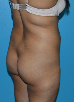 Brazilian Butt Lift Case 391 Before Photo Brazilian Butt Lift