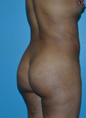 Brazilian Butt Lift Case 391 After Photo Brazilian Butt Lift