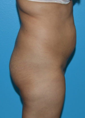 Brazilian Butt Lift Case 391 Before Photo Brazilian Butt Lift