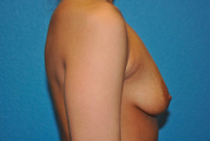 Breast Asymmetry Case 392 Before Photo Breast Asymmetry