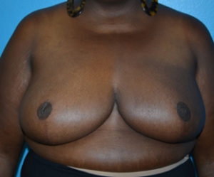 Breast Cancer Reconstruction Case 393 After Photo Breast Cancer Reconstruction
