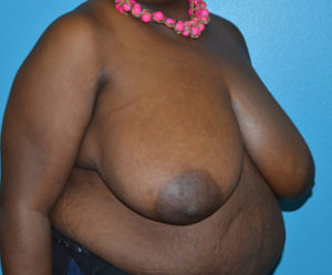 Breast Cancer Reconstruction Case 393 Before Photo Breast Cancer Reconstruction