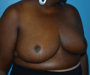 Breast Cancer Reconstruction Case 393 After Photo Breast Cancer Reconstruction