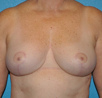 Breast Reduction Case 476 After Photo Breast Reduction