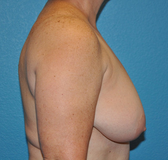 Breast Reduction Case 476 Before Photo Breast Reduction