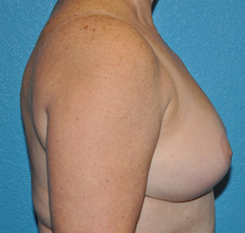 Breast Reduction Case 476 After Photo Breast Reduction