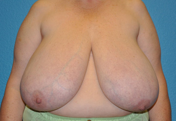Breast Reduction Case 493 Before Photo Breast Reduction