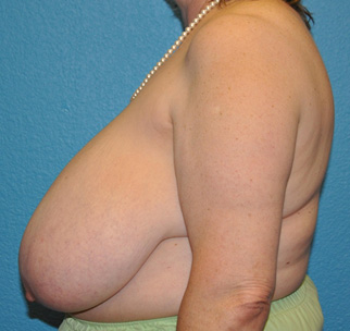 Breast Reduction Case 493 Before Photo Breast Reduction
