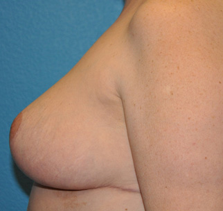 Breast Reduction Case 493 After Photo Breast Reduction
