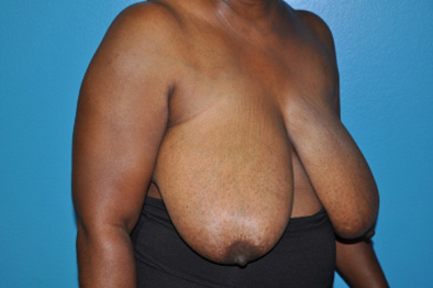 Breast Reduction Case 494 Before Photo Breast Reduction